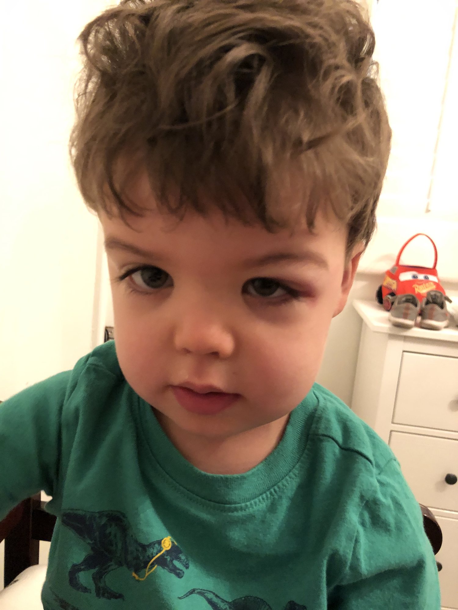 First black eye. Ben was kicked by another kid who was swinging on a play set. Whoops!